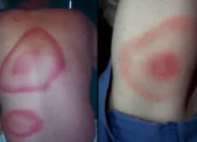 Lyme Disease, Si Kutu Nakal yang Bikin Bella Hadid Langganan Masuk RS
